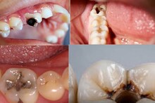 Dental Care: টুথপেস্টের বদলে দাঁত মাজুন নিম-সহ ৪ গাছের ডাল দিয়ে! ভুলবেন পোকা খাওয়া গর্ত দাঁতের ব্যথা! পোক্ত হবে ভাঙা আলগা দাঁত!