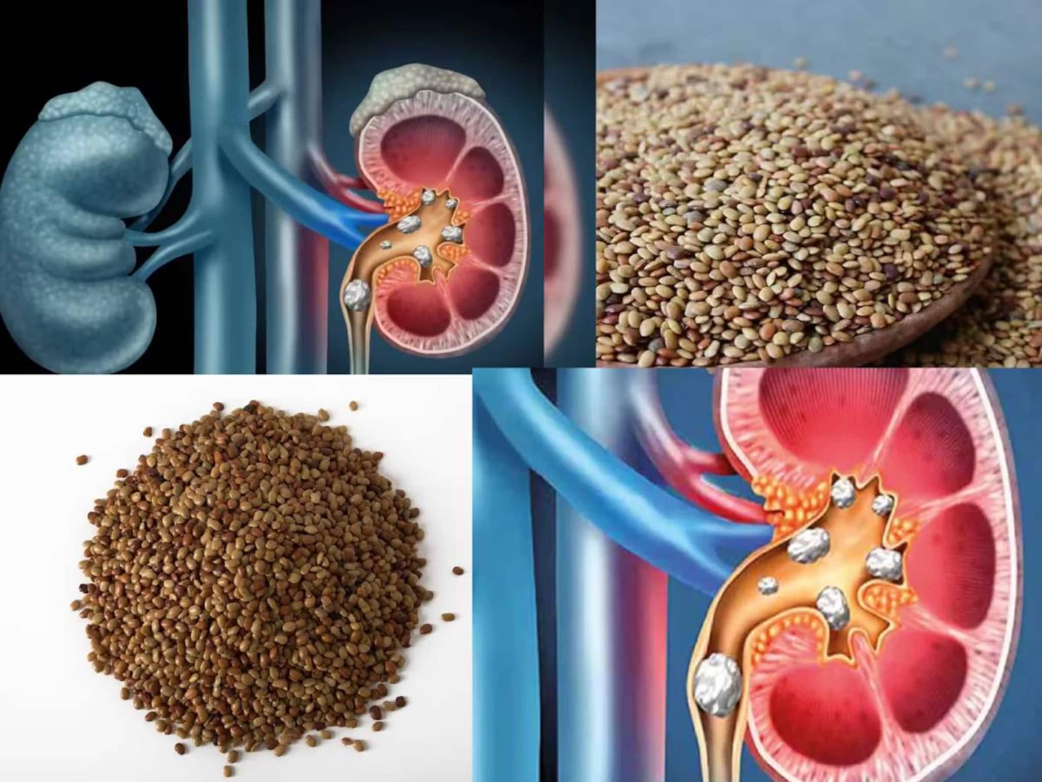 Kidney Stone: রোজ মাত্র ২৫ গ্রাম কুলথি ডাল! এভাবে খেলেই গুঁড়ো গুঁড়ো হয়ে গলে বেরিয়ে যাবে কিডনির পাথর! তবে বেশি খেলেই বিপদ!