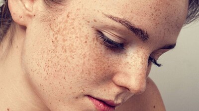 মুখ যত পরিষ্কার এবং নিখুঁত হয়, ততই সুন্দর দেখায়। সকলেই দাগমুক্ত, কালো দাগ, বলিরেখা বা দাগমুক্ত থাকতে চায়, কিন্তু যদি সঠিক ত্বকের যত্ন না নেওয়া হয়, তাহলে অল্প বয়সেও এই দাগ দেখা দিতে পারে। বার্ধক্যের লক্ষণগুলি কেবল আপনার ত্বকের সঠিক যত্ন নেওয়া, সঠিক পণ্য প্রয়োগ করা এবং স্বাস্থ্যকর খাবার খাওয়ার মাধ্যমেই প্রতিরোধ করা যেতে পারে। অনেক মহিলা, এমনকি অল্পবয়সী মেয়েরাও, দাগের সমস্যায় ভুগছেন। দাগ আসলে কী এবং মুখে এগুলোর কারণ কী? আসুন এখানে জেনে নেওয়া যাক। বলছেন ত্বক বিশেষজ্ঞ যতীন মিত্তল৷