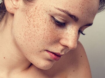 কোন ভিটামিনের অভাবে কালো দাগে ভরে মুখ? গ্লিসারিন, গোলাপজলের ম্যাজিকে পান ফুটফুটে মুখ