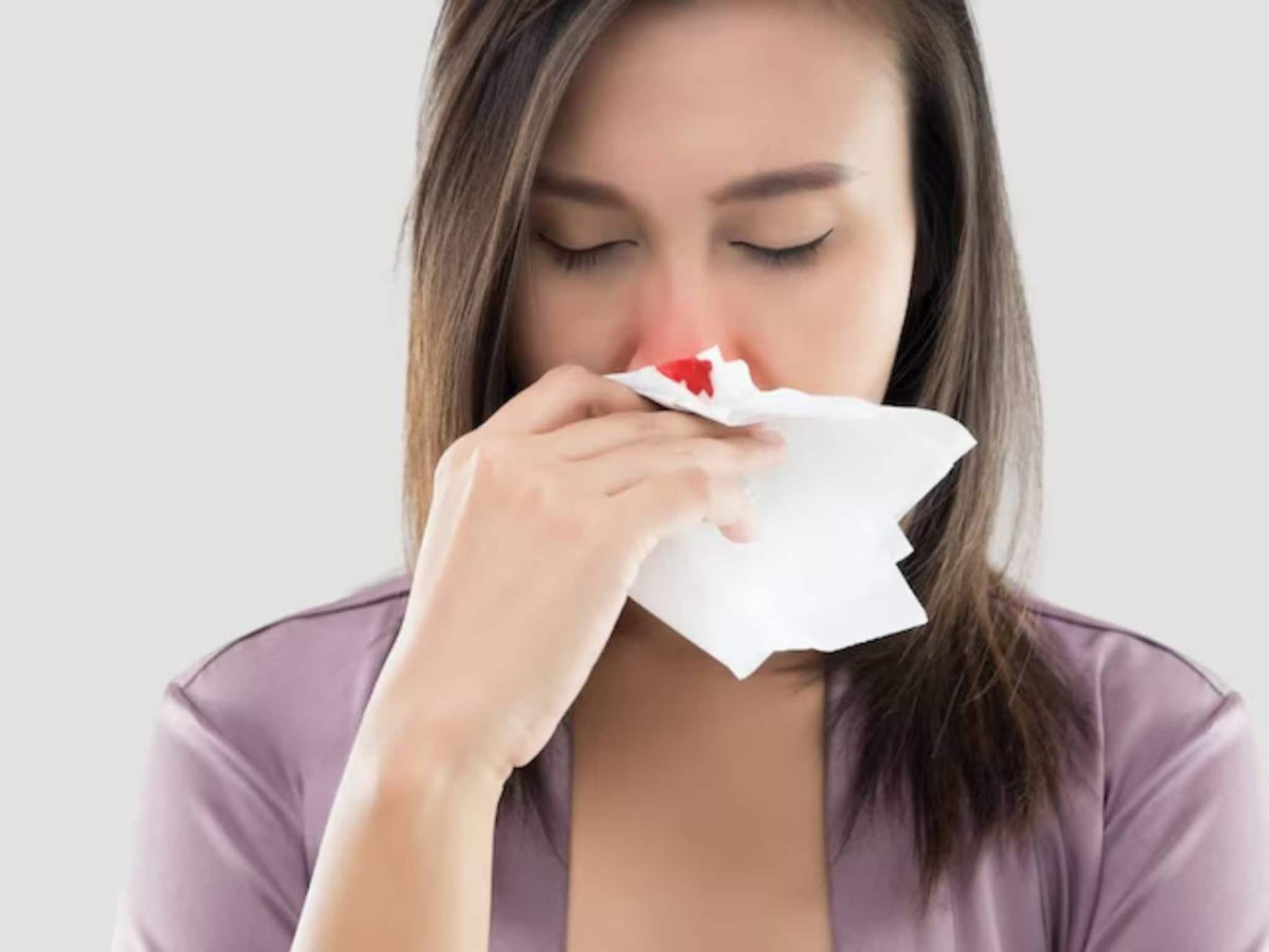 শীতকালে নাক দিয়ে রক্ত পড়ে কেন? রক্তপাত আটকাতে ব্রহ্মাস্ত্র নারকেল তেল! জানুন মোক্ষম টোটকা