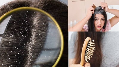 শীতের আগমনের সঙ্গে সঙ্গে খুশকি, চুলকানি এবং চুল পড়া হঠাৎ করে বেড়ে যায়, যার ফলে মানুষ বিভিন্ন শ্যাম্পু এবং চিকিৎসা চেষ্টা করে। কিন্তু আপনি যদি কোনও রাসায়নিক ছাড়াই শীতের এই চুলের সমস্যা থেকে মুক্তি পেতে চান, তাহলে আপনার বাড়ির আশেপাশে জন্মানো একটি সাধারণ গাছ গেম চেঞ্জার প্রমাণিত হতে পারে। এই গাছটি মাথার ত্বককে আর্দ্রতা দেয়, শিকড়কে শক্তিশালী করে এবং খুশকিকে মূল থেকে দূর করার ক্ষমতা রাখে। কেন অ্যালোভেরা শীতের সবচেয়ে কার্যকর প্রতিকার?