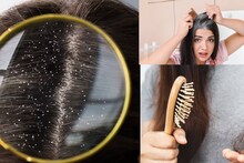 Dandruff & Hairfall: পাল্টে দেবে শীতের খেলা! দামি হেয়ার টনিক-তেলকে দশ গোল! অ্যালোভেরা জেলের গুণে সাফ খুশকি, বন্ধ চুল পড়া!