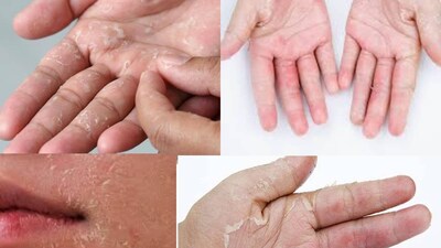 শীতকালে হাতে ফোস্কা দেখা দেওয়া, যা ‘হাথ কা আপরাস (ফোস্কা)’ নামেও পরিচিত, এটি অনেকেরই একটি প্রধান শীতকালীন সমস্যা। ঠান্ডা বাতাসের কারণে হাতের ত্বক খসখসে, রুক্ষ এবং সাদা দাগ দেখা দিতে পারে। ঘন ঘন হাত ধোয়া, সাবানের অতিরিক্ত ব্যবহার এবং ঠান্ডা জলের সংস্পর্শে আসার ফলে প্রায়শই এই সমস্যাটি আরও বেড়ে যায়। কিছু লোকের জ্বালাপোড়া এবং হালকা চুলকানিও হয়।