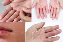 Skin Peeling: শীত পড়তেই চামড়া নরম হয়ে পেঁয়াজের খোসার মতো উঠে যায়? কয়েক ফোঁটা গ্লিসারিন, লেবুর রস এভাবে দিলেই গায়েব কষ্ট
