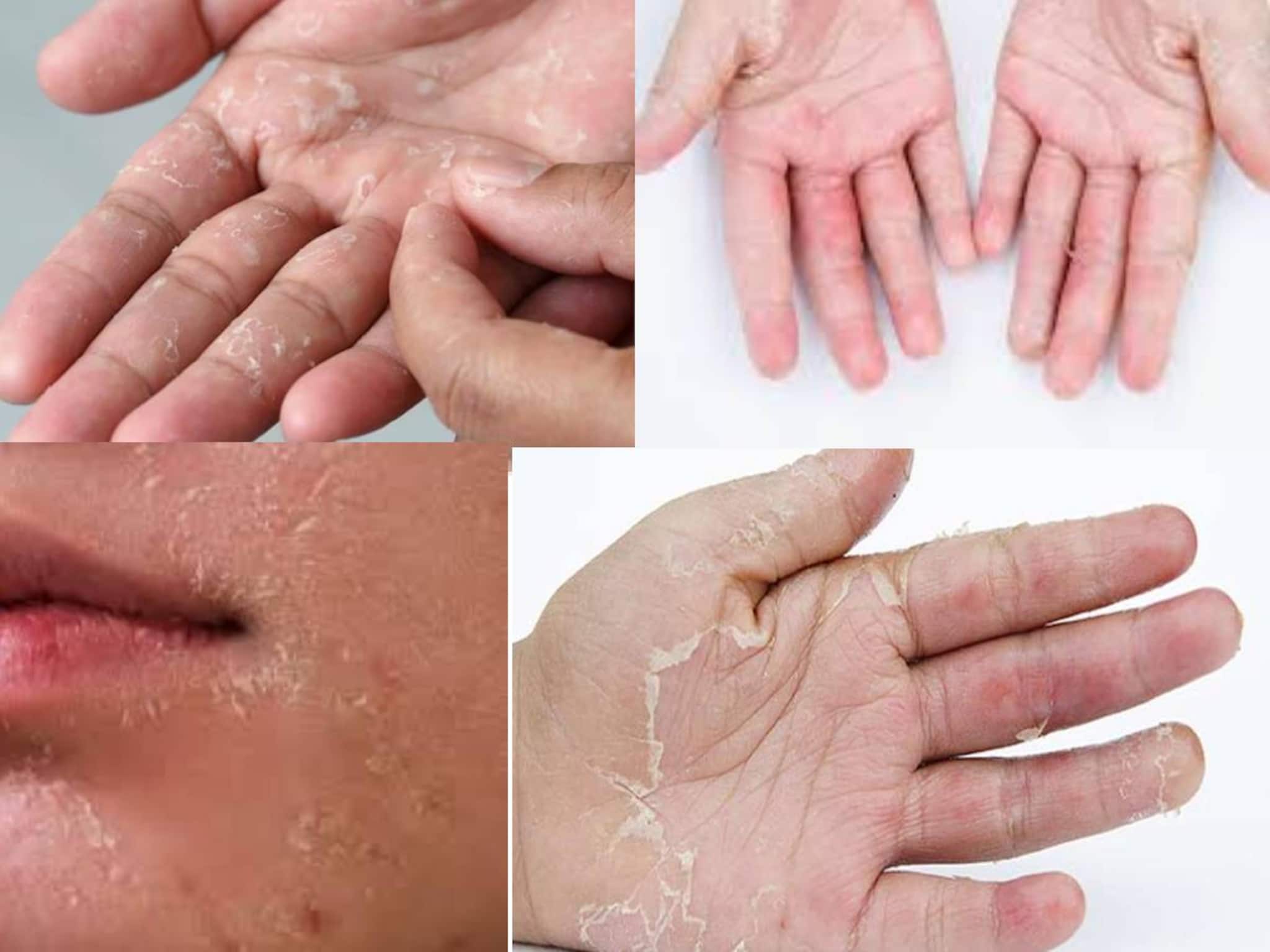 Skin Peeling: শীত পড়তেই চামড়া নরম হয়ে পেঁয়াজের খোসার মতো উঠে যায়? কয়েক ফোঁটা গ্লিসারিন, লেবুর রস এভাবে দিলেই গায়েব কষ্ট