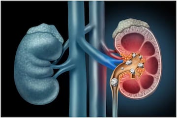 কিডনি ভাল রাখতে কম পটাশিয়াম খেতে হবে,জেনে নিন কোন ডালে কিডনি দীর্ঘদিন সুস্থ থাকবে কিডনি ভাল রাখতে কম পটাশিয়াম খেতে হবে,জেনে নিন কোন ডালে কিডনি দীর্ঘদিন সুস্থ থাকবে