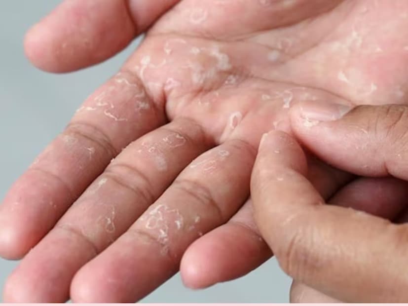 এ বিষয়ে আয়ুর্বেদিক চিকিৎসক পিবি দেওয়ান বলেন, শীতকালে হাতের তালুর ত্বকের উপরের স্তরটি প্রায়ই মৃত কোষ হিসেবে খোসা ছাড়তে শুরু করে। এটি সাধারণত ত্বকের আর্দ্রতা হ্রাস বা ত্বকে অতিরিক্ত ঠান্ডা স্পর্শ, অতিরিক্ত গরম জল ব্যবহার বা হালকা একজিমার কারণে ঘটে। এই সমস্যা এড়াতে হাতকে ময়েশ্চারাইজ করা উচিত।