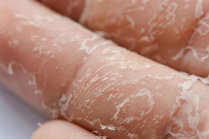 তিনি আরও বলেন, যদি সময়মতো যত্ন না নেওয়া হয়, তাহলে এই খসখসে শুষ্কতা ছোট ছোট ফাটলে পরিণত হতে পারে, যা সংক্রমণের ঝুঁকিও বাড়ায়, তাই এই ঋতুতে ত্বকের অতিরিক্ত যত্নের প্রয়োজন, যার জন্য সকালে স্নানের পর এবং রাতে ঘুমানোর আগে হাতে ময়েশ্চারাইজার লাগানো উচিত, যদি সম্ভব হয় তাহলে গ্লাভস পরা খুবই উপকারী।