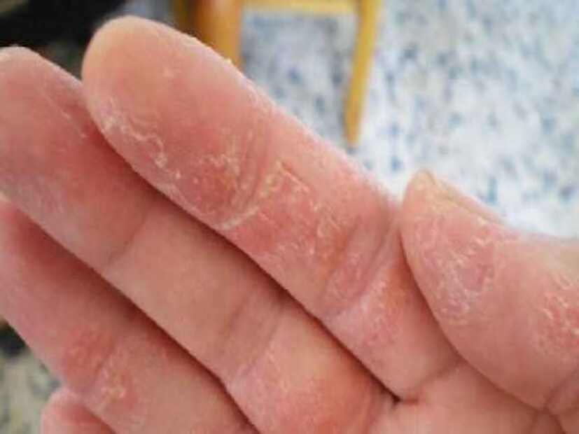 ডাঃ দিওয়ান হাতের ফোস্কা প্রতিরোধের ঘরোয়া প্রতিকার সম্পর্কে বলেন যে, নারকেল তেল লাগাতে হবে কারণ এটি ত্বককে ভেতর থেকে পুষ্টি জোগায় কারণ এর ছত্রাক-বিরোধী এবং ময়েশ্চারাইজিং বৈশিষ্ট্যের কারণে, গ্লিসারিন লাগালে ত্বকের আর্দ্রতা আটকে থাকে এবং হাত দীর্ঘ সময় ধরে নরম থাকে। এর পাশাপাশি, হালকা গরম জলে কয়েক ফোঁটা লেবু এবং মধু মিশিয়ে হাত ধোয়ার মাধ্যমেও আরাম পাওয়া যায়।