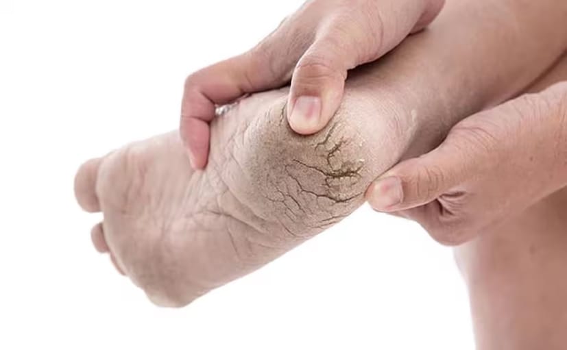 আপনার পায়ের যত্নের দিকে একটু বেশি মনোযোগ এবং যত্ন দিন, দিনে অন্তত দুবার ময়েশ্চারাইজার দিয়ে শুরু করুন। ইউরিয়া, স্যালিসিলিক অ্যাসিড, অথবা আলফা হাইড্রোক্সি অ্যাসিডের মতো ত্বক নরম করার উপাদানযুক্ত ময়শ্চারাইজার ব্যবহার করুন যা মৃত ত্বকের কোষ পরিষ্কার করতে সাহায্য করতে পারে।