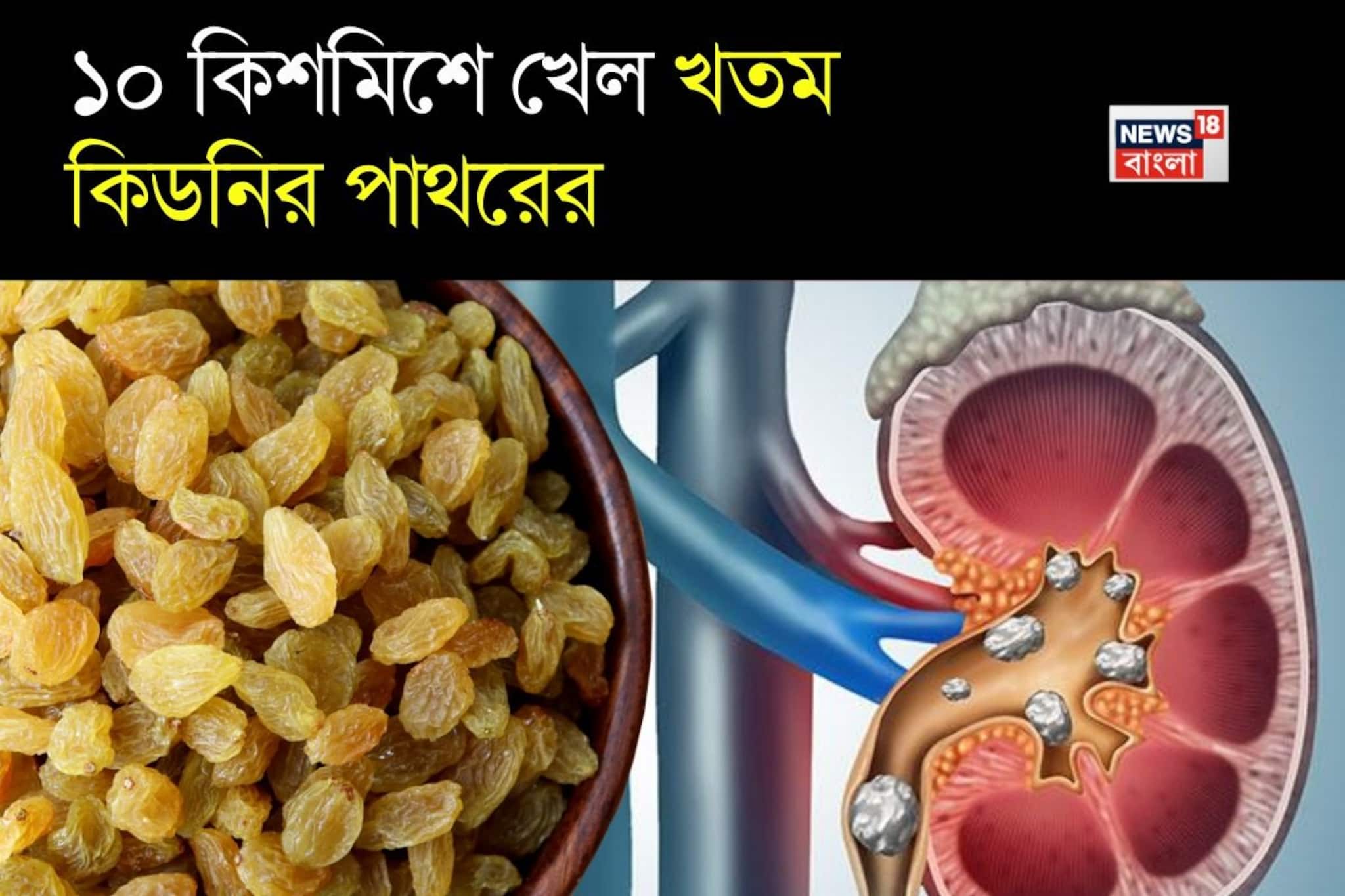 ১০ কিশমিশ...খেল খতম কিডনির পাথরের! সারবে প্রস্রাবের জ্বলুনি, তলপেটের ব্যথা ১০ কিশমিশ...খেল খতম কিডনির পাথরের! সারবে প্রস্রাবের জ্বলুনি, তলপেটের ব্যথা