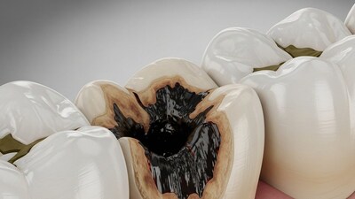 দাঁতে ব্যথা হলে কষ্টে ছটফট করতে হয়। কিন্তু তাই বলে কথায় কথায় মুঠো মুঠো পেইনকিলার খাওয়ার কোনও মানে নেই। ডাক্তারের কাছে যাওয়ার আগে ঘরোয়া উপকরণে কমান যন্ত্রণা। অসহ্য হলেও দাঁতের ব্যথা কমানোর টোটকা কিন্তু হাজির হাতের কাছেই। যদি সময়মতো ঘরোয়া প্রতিকার গ্রহণ করা হয়, তাহলে দাঁত ব্যথা এবং ক্ষয় দুই-ই জব্দ হয়।