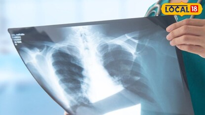 এক্স-রে প্লেট (প্রতীকী ছবি) এক্স-রে প্লেট (প্রতীকী ছবি)