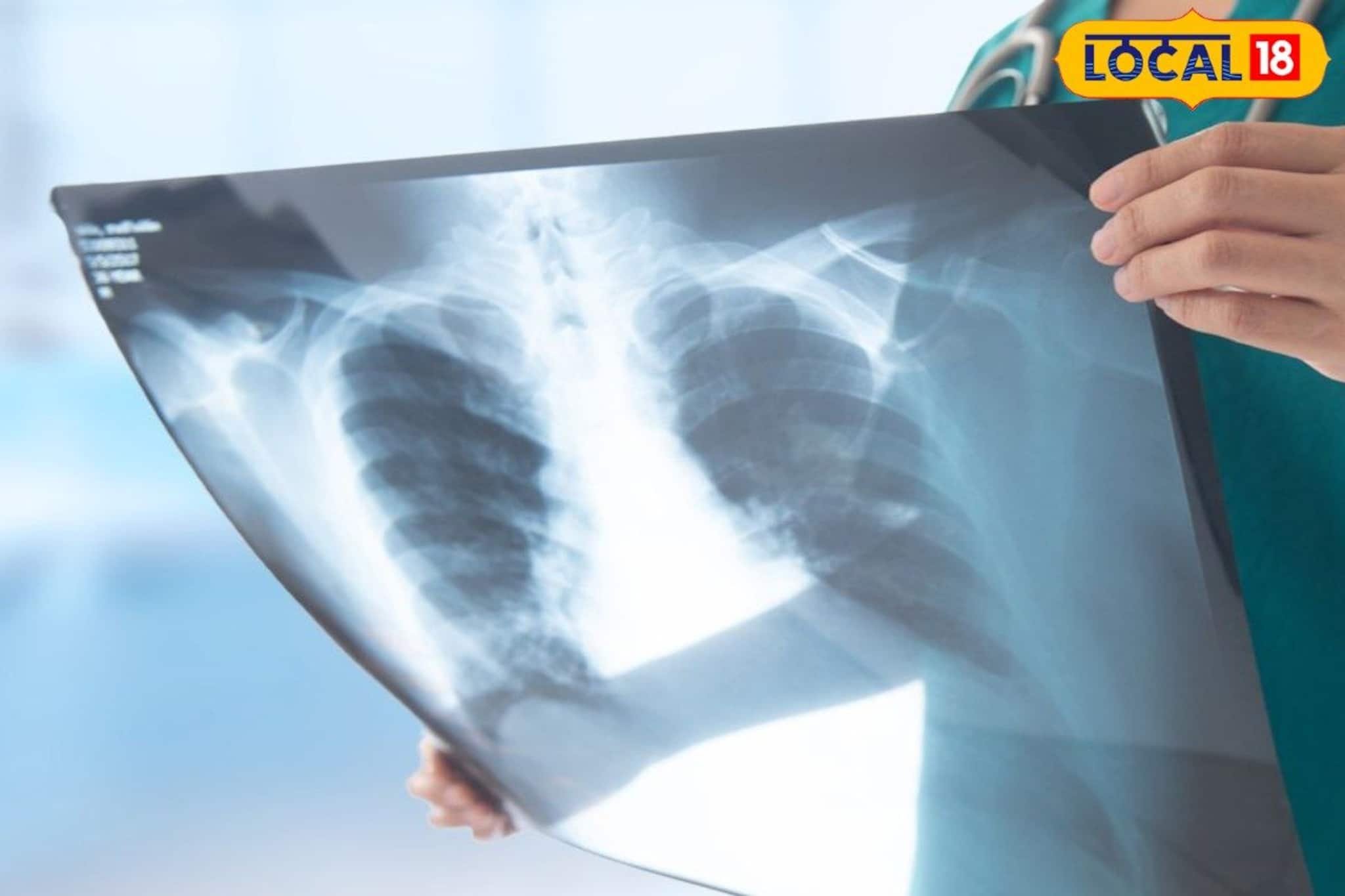 নিউজ ১৮ বাংলার খবরের জের! আলিপুরদুয়ার হাসপাতালে চালু হল দেড় মাস বন্ধ থাকা এক্স-রে মেশিন