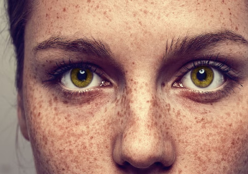 মেলানিন আমাদের ত্বকের রং নির্ধারণ করে এবং সূর্যের ক্ষতিকর অতিবেগুনি রশ্মি থেকে ত্বককে রক্ষা করে।
বেশিক্ষণ রোদে থাকলে শরীর ত্বককে রক্ষা করতে মেলানিন উৎপাদন বাড়িয়ে দেয়। তখন ত্বকের কোনও কোনও অংশে মেলানিন বেশি পরিমাণে জমা হয় এবং সেখানেই ফ্রেকলস তৈরি হয়।