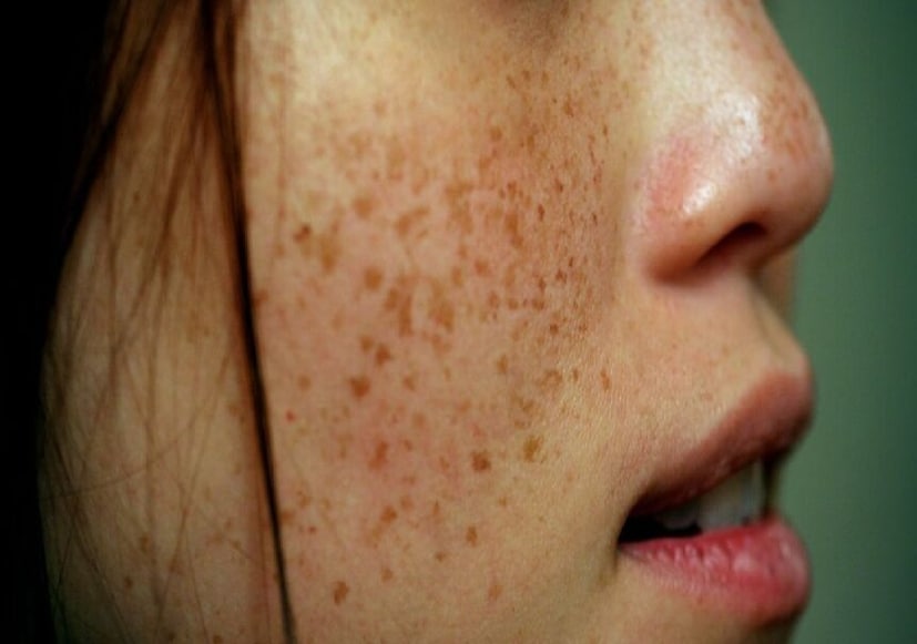 ফ্রেকলস দূর করতে অনেকেই গাদাগাদা ক্রিম-সিরাম-লোশন মাখেন, অনেকেই পার্লারে কাঁড়িকাঁড়ি টাকা খরচ করেন। কিন্তু লাভ আখেরে তেমন কিছুই হয় না! উলটে কসমেটিক্সে থাকা কেমিক্যাল ত্বকের আরও ক্ষতি করে। আয়ুর্বেদ মতে, ফ্রেকেলস হওয়ার মূল কারণ পিত্ত দোষের সামঞ্জস্য নষ্ট হয়ে যাওয়া। পাশাপাশি বেশি রোদে বার হলেও বেড়ে যায় ফ্রেকলস, তার সঙ্গে বাড়ে মেলাসমার মতো ত্বকের সমস্যার ঝুঁকি।