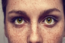 Get Rid Of Freckles Of Skin: রোদে বার হলেই ত্বকে বাদামী দাগছোপ বা ফ্রেকলস? কসমেটিক্স নয়, জেনে নিন কোন ভিটামিনের অভাবে এমনটা হয়