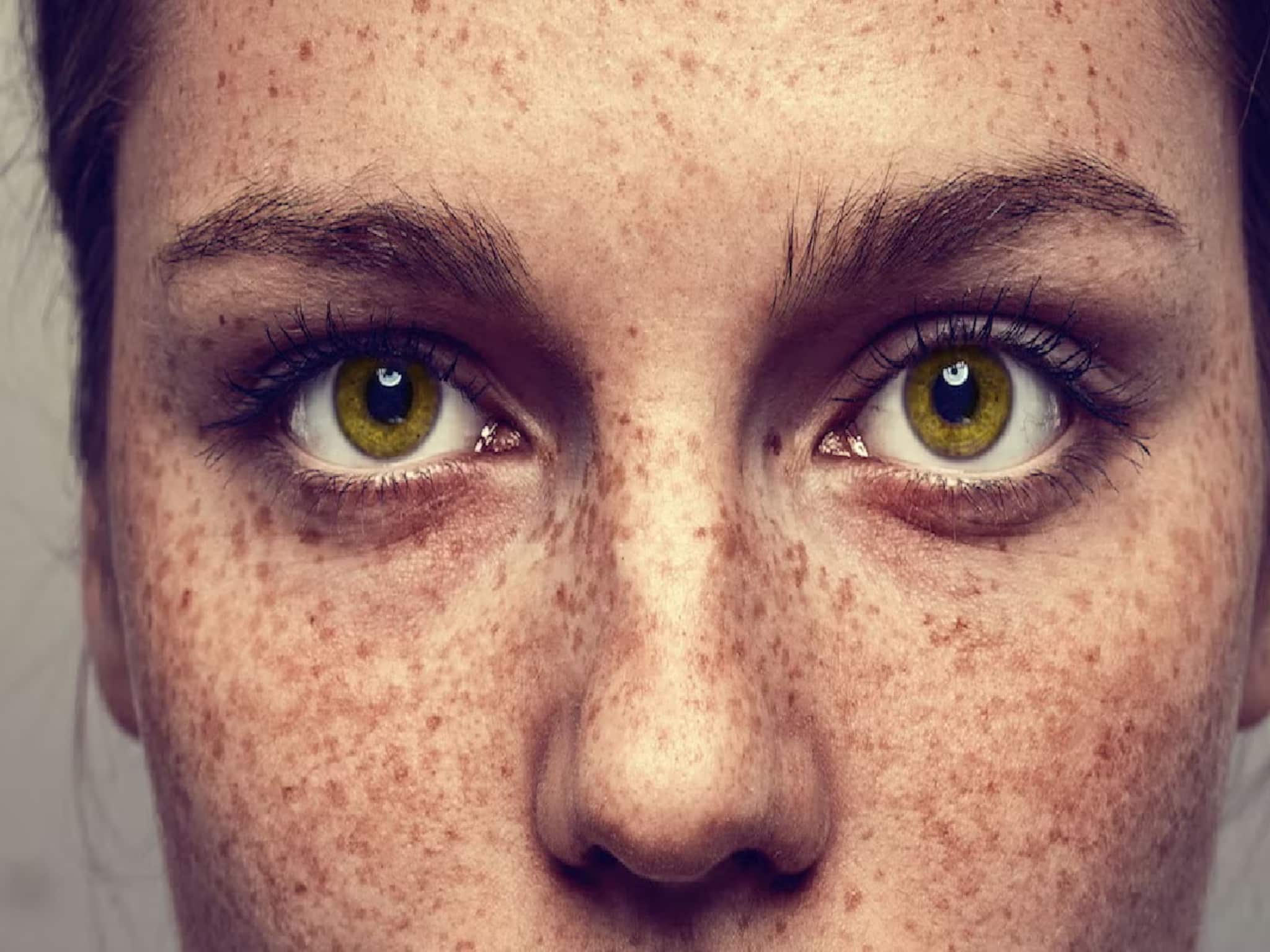 ত্বকে বাদামী দাগছোপ বা ফ্রেকলস? কসমেটিক্স নয়, জেনে নিন কোন ভিটামিনের অভাবে এমনটা হয় ত্বকে বাদামী দাগছোপ বা ফ্রেকলস? কসমেটিক্স নয়, জেনে নিন কোন ভিটামিনের অভাবে এমনটা হয়