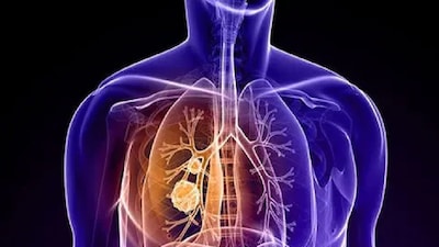 Symptoms That Don’t Seem Like Lung Cancer But Actually Are