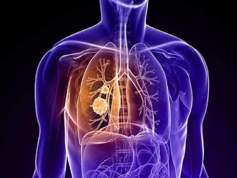 ফলে যে রোগ একসময় প্রায় নিশ্চিত মৃত্যুর দিকে নিয়ে যেত, সেটিই এখন অনেক ক্ষেত্রে দীর্ঘমেয়াদি, নিয়ন্ত্রিত অসুখ হিসেবে ব্যবস্থাপনাযোগ্য হয়ে উঠেছে। আগামী দিনে প্রতিরোধমূলক ব্যবস্থা, ধূমপান-বিরোধী প্রচার, দূষণ নিয়ন্ত্রণ এবং কর্মক্ষেত্রে সুরক্ষা নিশ্চিত করাই মূল লক্ষ্য হওয়া উচিত।