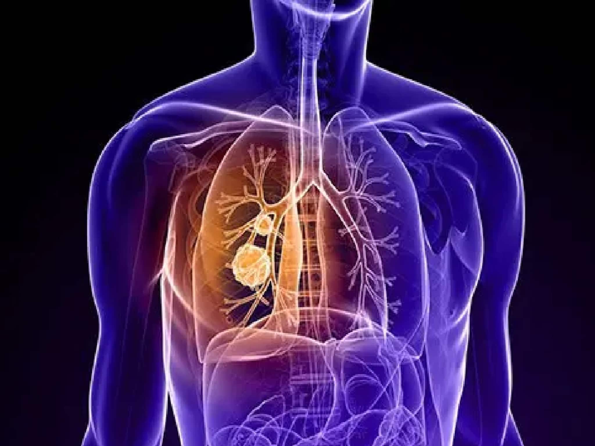 Lung Cancer Symptoms: যে উপসর্গগুলো আমরা 'সাধারণ শরীর খারাপ' বলে এড়িয়ে যাই, অথচ সেগুলোই হতে পারে ফুসফুসের ক্যানসারের লক্ষণ, যা বলছেন চিকিৎসক