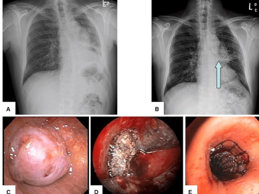 ভারতে এই রোগকে দীর্ঘদিন ধরে মূলত ধূমপায়ী ও বয়স্কদের অসুখ হিসেবে দেখা হত, কিন্তু এখন ক্রমশই বেশি সংখ্যায় অধূমপায়ী এবং অপেক্ষাকৃত তরুণ রোগীর মধ্যে এই ক্যান্সার শনাক্ত হচ্ছে। বায়ুদূষণ, প্যাসিভ স্মোকিং, কর্মক্ষেত্রে বিষাক্ত পদার্থের সংস্পর্শ এবং জেনেটিক কারণ—সব মিলিয়ে ঝুঁকি বাড়ছে।