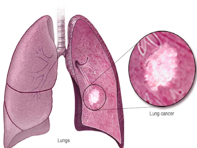 উচ্চ ঝুঁকির ক্ষেত্রেই লো-ডোজ সিটি স্ক্রিনিংয়ের কার্যকারিতা প্রমাণিত—৫০ বছরের বেশি বয়সী এবং দীর্ঘমেয়াদি ধূমপানের ইতিহাস থাকা ব্যক্তিদের ক্ষেত্রে এই স্ক্রিনিংয়ে মৃত্যুহার প্রায় ২০ শতাংশ কমে। তবে ভারতে এই ধরনের সংগঠিত স্ক্রিনিং এখনও খুব সীমিত এবং বহু বাস্তব সমস্যার সম্মুখীন—অধূমপায়ী রোগীর সংখ্যা বেড়ে যাওয়া, টিবির মতো রোগের কারণে ভুল রিপোর্ট পাওয়া, এবং পরিকাঠামোর অভাব।