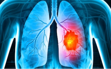 ফুসফুসের ক্যানসারের যে উপসর্গগুলো আমরা 'সাধারণ শরীর খারাপ' বলে এড়িয়ে যাই, যা বলছেন চিকিৎসক ফুসফুসের ক্যানসারের যে উপসর্গগুলো আমরা 'সাধারণ শরীর খারাপ' বলে এড়িয়ে যাই, যা বলছেন চিকিৎসক