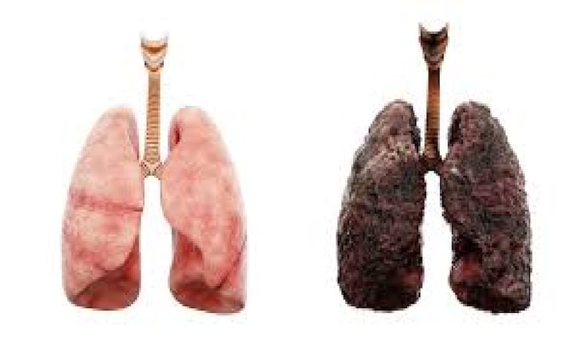 দুর্ভাগ্যজনক ভাবে, অধিকাংশ রোগী উন্নত পর্যায়ে চিকিৎসকের কাছে আসেন, যখন অস্ত্রোপচার আর সম্ভব থাকে না এবং নিরাময়ের সুযোগও কমে যায়। এর অন্যতম কারণ হল, রোগের শুরুর লক্ষণ প্রায় নীরব—সামান্য কাশি বা শ্বাসকষ্টকে সাধারণ সংক্রমণ ভেবে অবহেলা করা হয়, এবং টিবি বা সিওপিডির মতো দীর্ঘস্থায়ী রোগ থাকলে ফুসফুসের ক্যান্সার আরও আড়ালে থেকে যায়।