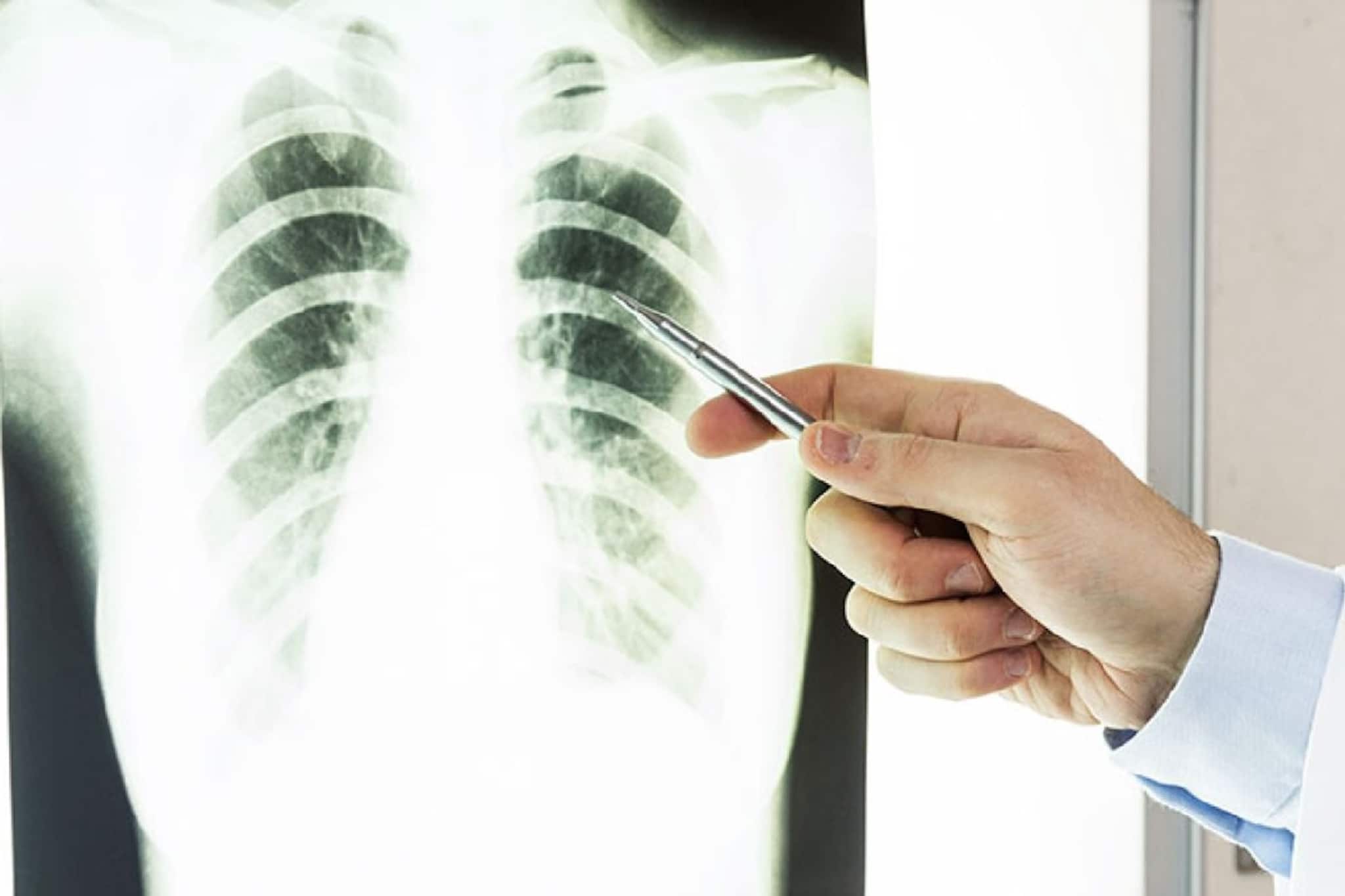 Lung Cancer। লক্ষণ দেখেও ফেলে রাখার ফল! ফুসফুসের ক্যানসার কখন ধরা পড়লে সারে? জানাচ্ছেন চিকিৎসক