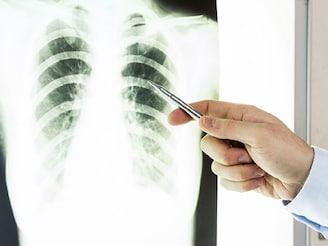 লক্ষণ দেখেও ফেলে রাখার ফল! ফুসফুসের ক্যানসার কখন ধরা পড়লে সারে? জানাচ্ছেন চিকিৎসক