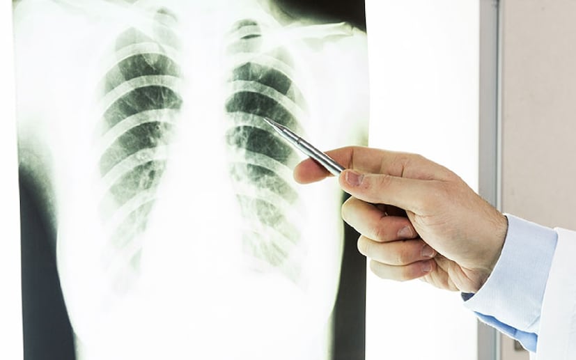 স্ক্রিনিং, আধুনিক ডায়াগনস্টিক প্রযুক্তি এবং টার্গেটেড থেরাপিতে যথেষ্ট অগ্রগতি সত্ত্বেও ফুসফুসের ক্যান্সার এখনও বিশ্বজুড়ে ক্যান্সার-জনিত মৃত্যুর প্রধান কারণ। অথচ এই মৃত্যুর একটি বড় অংশ প্রতিরোধযোগ্য, এবং রোগটি প্রাথমিক পর্যায়ে শনাক্ত করা গেলে রোগীর বাঁচার সম্ভাবনা উল্লেখযোগ্যভাবে বেড়ে যায়।