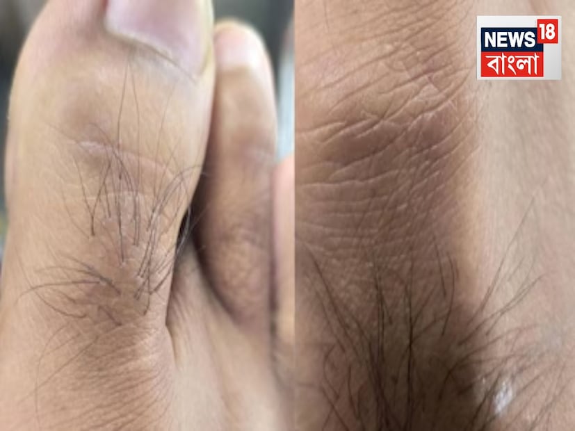 এটা যে সুস্বাস্থ্য অথবা দুর্বল স্বাস্থ্যের কোনও লক্ষণ হতে পারে, এতো আমাদের জানাই ছিল না৷ পায়ের আঙুলে বড় চুল বা লোম কোনও মানুষের হৃৎপিণ্ডের স্বাস্থ্যের দিকে অদৃশ্য বার্তা দিতে পারে৷ নয়ডার চিকিৎসক ডা. শ্রাদ্ধে কাটিয়ার এবিষয়ে বিশদে ব্যাখ্যা দিয়েছেন৷