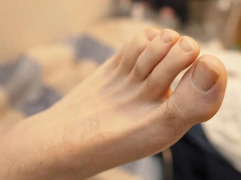 যদিও শুধু মাত্র পায়ের বুড়ো আঙুলে চুল না থাকা দিয়েই রোগ আছে কি না তা নির্ধারণ করা যায় না৷ তবে, কাটিহার মনে করেন পায়ের বুড়ো আঙুলে চুল না থাকার পাশাপাশি, কারও যদি কোল্ড ফিট, পায়ে ঝিন ধরা, কেটে গেলে সহজে না শুকনোর মতো সমস্যাও থাকে, তাহলে অবশ্যই চেক আপ করানো উচিত৷ 