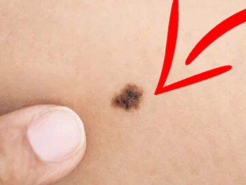 আপনার শরীরের এই অংশে তিল রয়েছে? তাহলেই খুলে যাবে ভাগ্য! কপাল জোরে সাত প্রজন্মেও টাকার টান