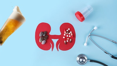 Urologist Debunks Beer Myth: It Doesn't Cure Kidney Stones, Can Harm!