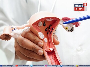 যৌ*ন সম্পর্কের পরে এই একটা লক্ষণ...হতে পারে সার্ভিক্যাল ক্যানসারের প্রাথমিক symptom