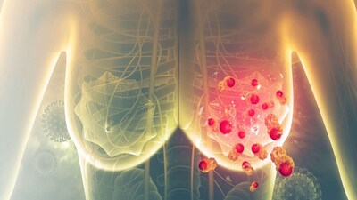 স্তন ক্যানসার। প্রতীকী ছবি। 