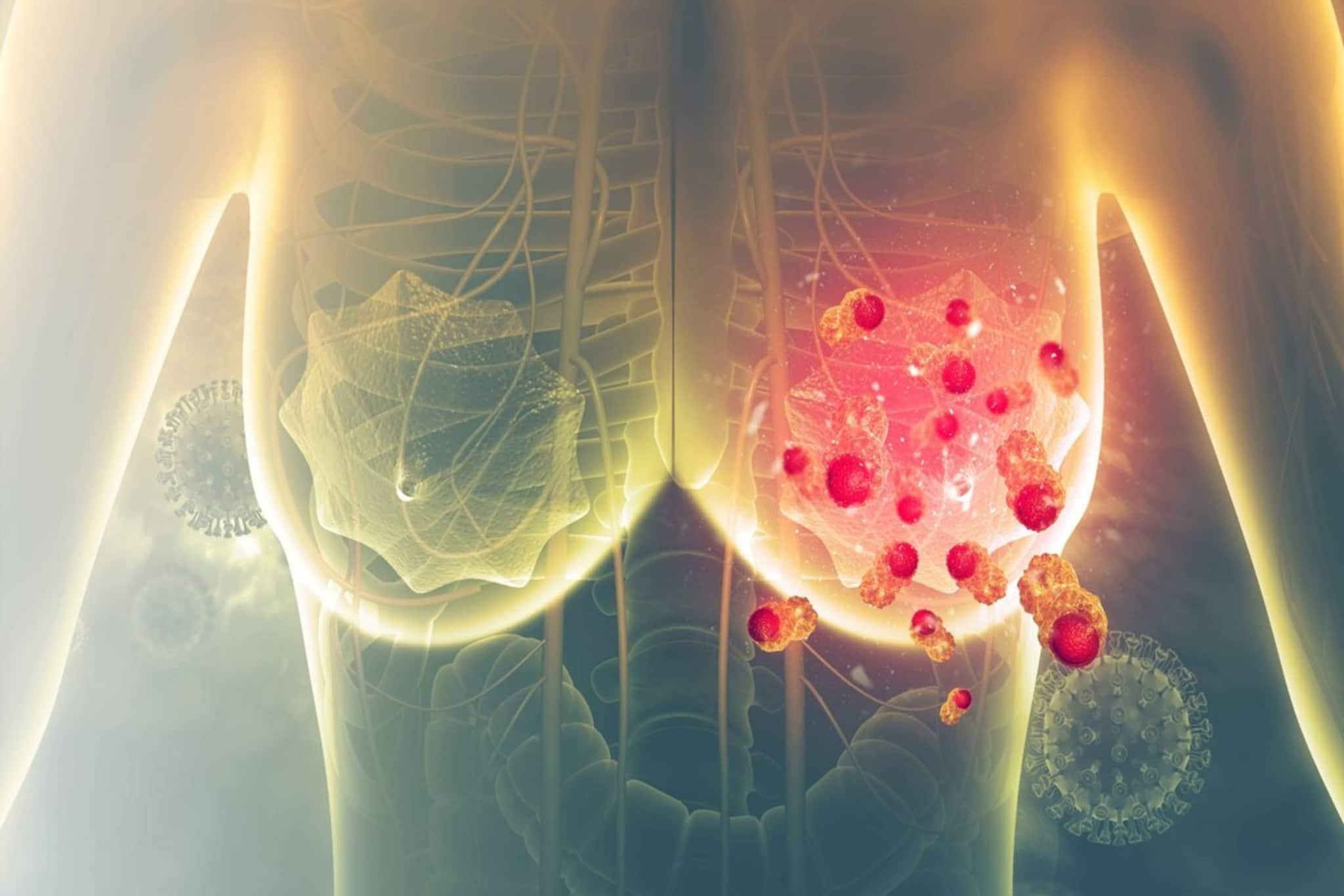 দুর্বার গতিতে বাড়ছে স্তন ক্যানসার! ভারতীয়দের মধ্যে কোন কারণগুলি বেশি ঝুঁকিপূর্ণ? দুর্বার গতিতে বাড়ছে স্তন ক্যানসার! ভারতীয়দের মধ্যে কোন কারণগুলি বেশি ঝুঁকিপূর্ণ?