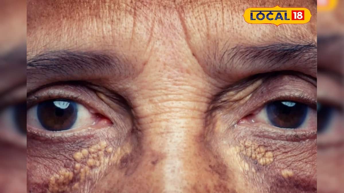 Cholesterol: লুকিয়ে শরীর বেড়েছে কোলেস্টেরলের মাত্রা! ত্বক দেখে বুঝবেন ১ মিনিটে, লক্ষণ বলে দিলেন চিকিৎসক Cholesterol: লুকিয়ে শরীর বেড়েছে কোলেস্টেরলের মাত্রা! ত্বক দেখে বুঝবেন ১ মিনিটে, লক্ষণ বলে দিলেন চিকিৎসক