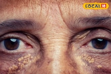 Cholesterol: লুকিয়ে শরীর বেড়েছে কোলেস্টেরলের মাত্রা! ত্বক দেখে বুঝবেন ১ মিনিটে, লক্ষণ বলে দিলেন চিকিৎসক