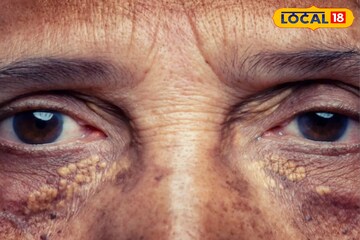 লুকিয়ে শরীর বেড়েছে কোলেস্টেরলের মাত্রা! ত্বক দেখে বুঝবেন ১ মিনিটে, লক্ষণ বলে দিলেন চিকিৎসক