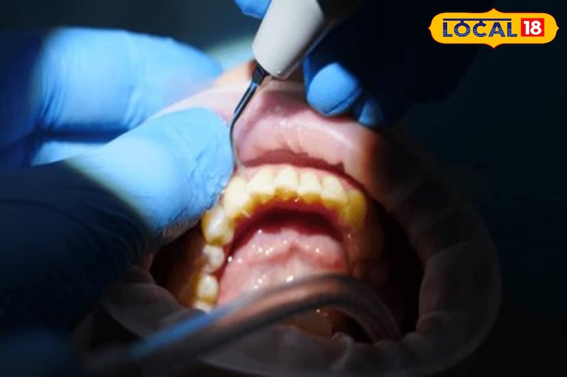 শীতকাল এলেই অনেকের দাঁত ও মাড়ির সমস্যা বেড়ে যায়। ঠান্ডা আবহাওয়ায় দাঁতে শিরশির ভাব, মাড়ি ফুলে যাওয়া বা রক্তপাতের মতো সমস্যা বেশি দেখা যায়। বিশেষজ্ঞদের মতে, শীতে রক্ত সঞ্চালন কমে যাওয়া এবং মুখের ভেতর শুষ্কতা বেড়ে যাওয়ার কারণেই এই ধরনের সমস্যা বাড়ে। তাই শীতকালে দাঁতের বিশেষ যত্ন নেওয়া অত্যন্ত জরুরি। (ছবি ও তথ্য: রঞ্জন চন্দ)