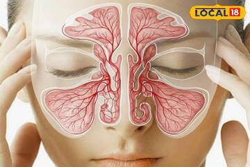 শীতে সাইনাসের সমস্যা বেড়েছে ? গাদাগাদা ওষুধ নয়,সহজ ঘরোয়া উপায়ে আরাম পান