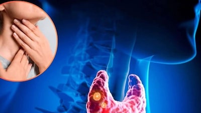 থাইরয়েড ক্যানসার তখন ঘটে যখন অস্বাভাবিক থাইরয়েড কোষগুলি অনিয়ন্ত্রিতভাবে বৃদ্ধি পায়, প্রায়ই ঘাড়ে একটি পিণ্ড বা নোডিউল তৈরি করে। যদিও বেশিরভাগ থাইরয়েড নোডিউল নিয়ে উদ্বেগ থাকে না, তবে একটি কম শতাংশ মারাত্মক হতে পারে। প্যাপিলারি থাইরয়েড ক্যানসারের প্রাথমিকভাবে চিকিৎসা করা হলে একটি চমৎকার পূর্বাভাস পাওয়া যায়।