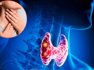 থাইরয়েড ক্যানসারের লক্ষণ কী কী? কখন যাবেন চিকিৎসকের কাছে? জেনে নিন