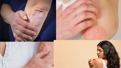 ঠান্ডা আবহাওয়া, কম আর্দ্রতা ত্বককে মারাত্মকভাবে শুষ্ক করে তুলতে পারে, একজিমার প্রকোপ বৃদ্ধি করে, সোরিয়াসিসকে আরও খারাপ করে এবং শীতকালে সামগ্রিক শুষ্কতা বৃদ্ধি করে? ঋতু পরিবর্তন ত্বকের স্বাস্থ্যের উপর উল্লেখযোগ্য প্রভাব ফেলতে পারে, যার ফলে প্রতিরোধমূলক ব্যবস্থা গ্রহণ করা অপরিহার্য হয়ে পড়ে। বলছেন চর্মরোগ বিশেষজ্ঞ শরিফা চৌস৷