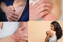 Eczema & Psoriasis: একজিমা, সোরিয়াসিসে ভরে যাবে চামড়া! কিছু কাজ ভুলেও করবেন না শীতে! ত্বক ঢেকে যাবে রোগে!