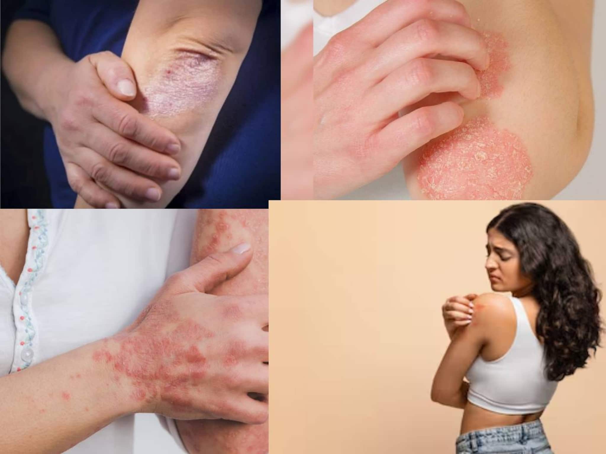 একজিমা, সোরিয়াসিসে ভরে যাবে চামড়া! কিছু কাজ ভুলেও করবেন না শীতে! ত্বক ঢেকে যাবে রোগে!